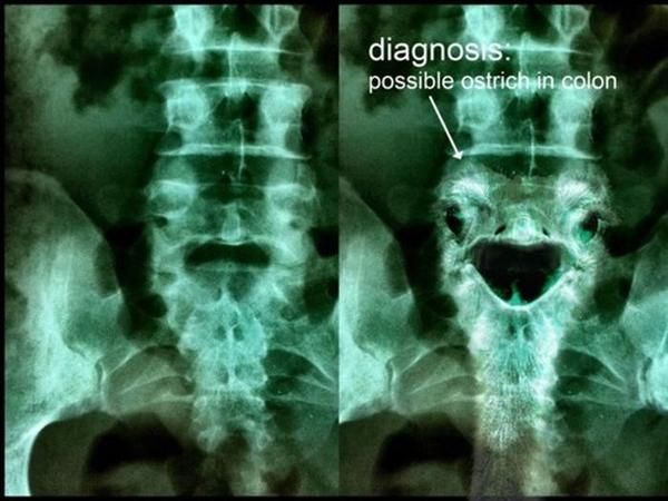 diagnosis:
 possible ostrich in colon